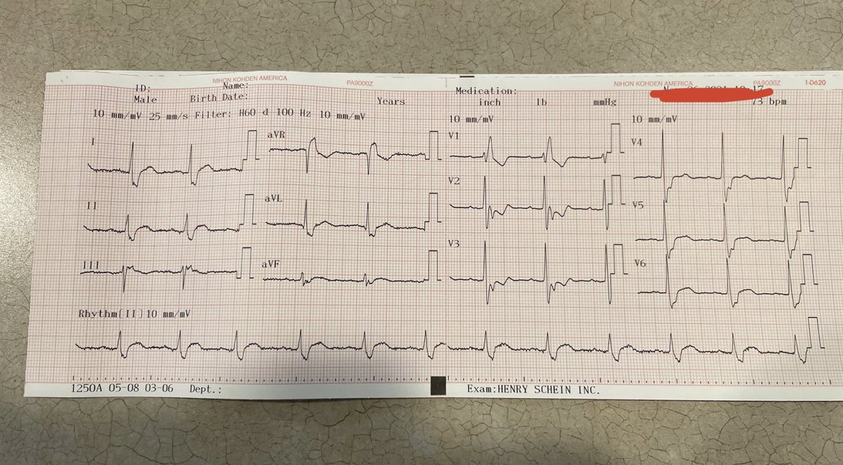 Patient I saw at the urgent care I work at, 54 yo AAM past medical history of hypertension and hyperlipidemia. Blood pressure of 180/100, asymptomatic and otherwise normal exam <a href="/EM_RESUS/">Sam Ghali, M.D.</a> <a href="/CardiacPA1/">Notorious EKG⚡</a> #CardioTwitter thoughts?
