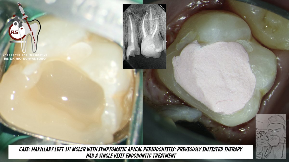 another case of a single visit endodontic treatment on maxillary first molar with 4 canals, the mesial canals were confluence at the apical third and from the final xray revealed the existence of lateral canal. 
of course the rubber dam is a must.. 
HAPPY DAY!