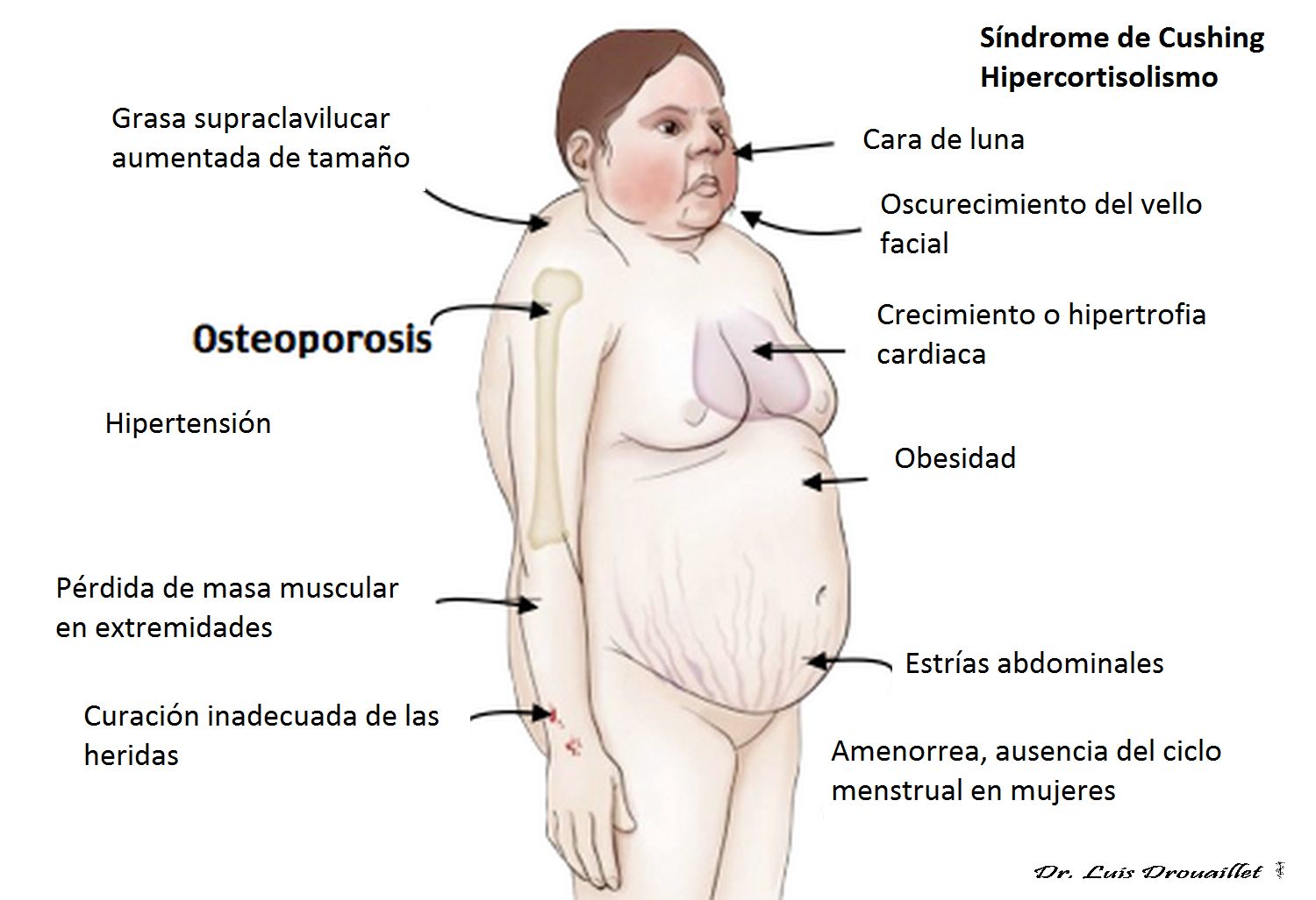 Síndrome hiperglucémico hiperosmolar cetosis