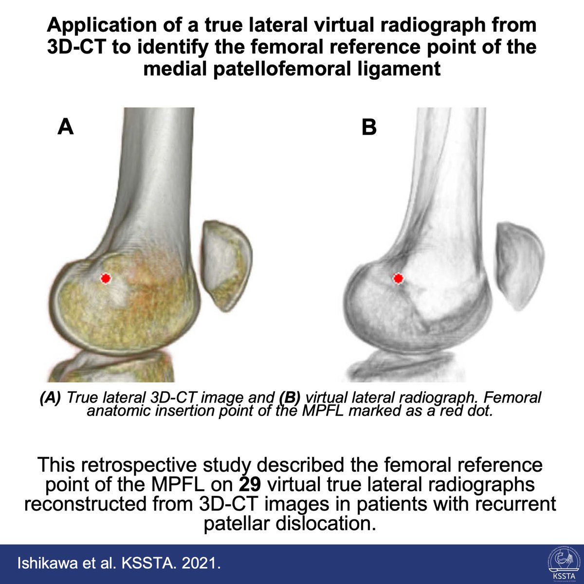 KSSTA's tweet photo. Where is the femoral reference point in MPFL reconstruction in patients with recurrent patellar dislocation? Is Schöttle’s point still appropriate? Check out this study of the November issue of KSSTA.

#sportstraumatology #MPFL #patellardislocation 

https://t.co/iXpVPZSS3L https://t.co/TAU8dh1oGF