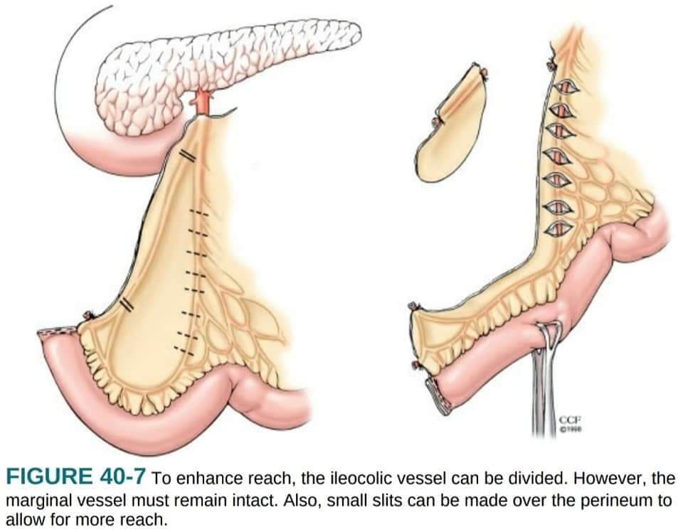 DRAFTABAHMED7's tweet photo. “𝗣𝗶𝗲 𝗰𝗿𝘂𝘀𝘁𝗶𝗻𝗴" & 𝗹𝗲𝗻𝗴𝘁𝗵𝗲𝗻𝗶𝗻𝗴 of the bowel mesentery:
@IHPBA
@AHPBA
#SoMe4HPB
#SoMe4IQLatAm #SoMe4Surgery #Medtwitter
#4KMedEd #LiverTwitter
#MedicalEducation
#USMLE
#surgery
#pancrease https://t.co/CAY21O7q91