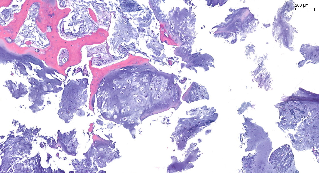 FliquiPath's tweet image. Cartilaginous lesion. Entrapment or encasement?🤔
#BSTPath #pathology #twitterpath #residentspath #digipath