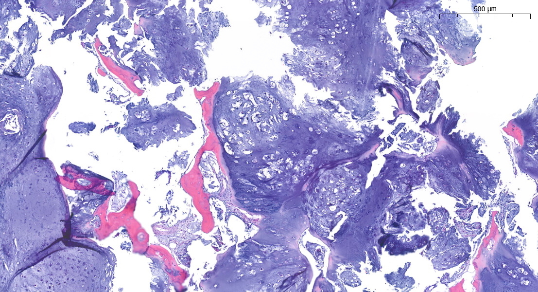 FliquiPath's tweet image. Cartilaginous lesion. Entrapment or encasement?🤔
#BSTPath #pathology #twitterpath #residentspath #digipath