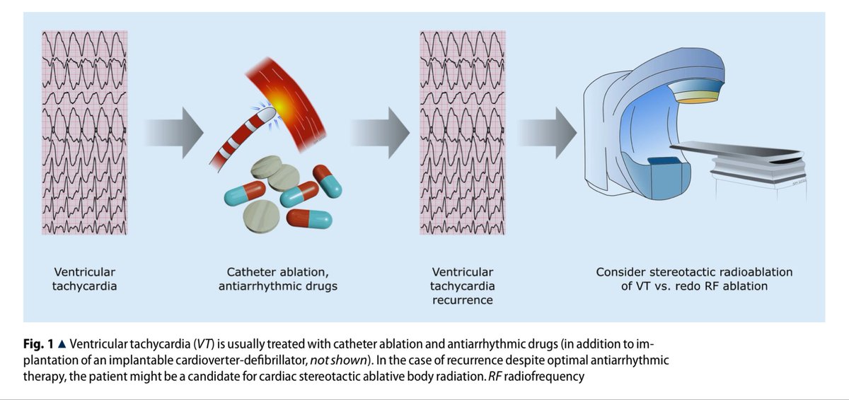 DavidDuncker's tweet photo. Stereotactic radioablation for VT

🏁current clinical evidence
🏁relevant preclinical &amp; translational results
🏁practical guidance
🏁cardiac radioablation planning &amp; treatment workflow

@SHohmannMD @HenrikeHillmann @MuellerLeisse @chris_zormpas @DrV_Mann 

https://t.co/2dNzCD6WZE https://t.co/y9xPbVCquU