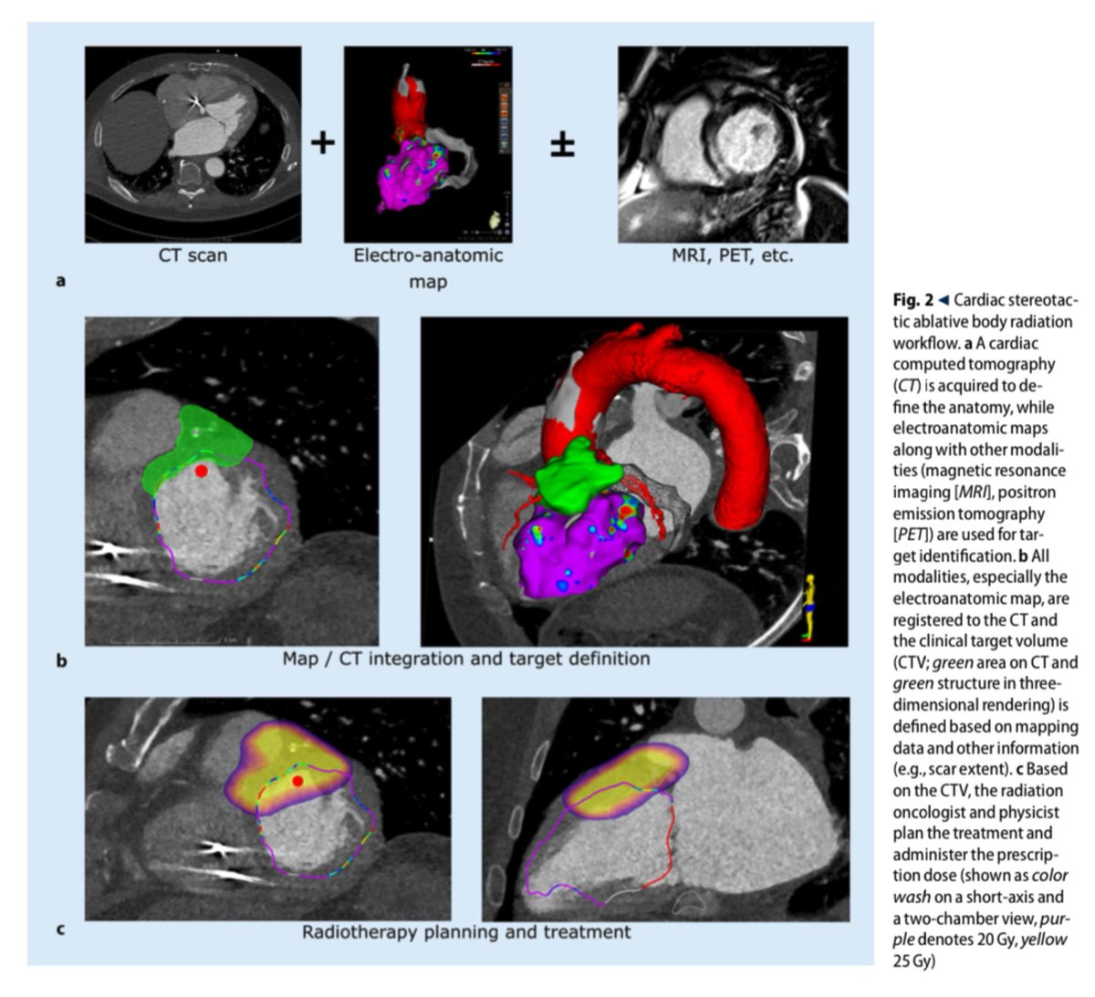 DavidDuncker's tweet photo. Stereotactic radioablation for VT

🏁current clinical evidence
🏁relevant preclinical &amp; translational results
🏁practical guidance
🏁cardiac radioablation planning &amp; treatment workflow

@SHohmannMD @HenrikeHillmann @MuellerLeisse @chris_zormpas @DrV_Mann 

https://t.co/2dNzCD6WZE https://t.co/y9xPbVCquU