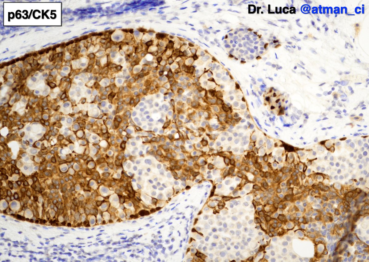 atman_ci's tweet photo. Thanks all! @ADamronMD your synthesis is perfect! radial scar with UDH and CCC/CCH admixed with LCIS, you all deserve a wonderful contrast between p120 and p63/CK5 combo @LoboAnandi @DrBMcGinn @QassidO @kis_lorand @RizviUroos @quilla_sara #PathTwitter #PathResidents #BreastPath https://t.co/XFFZUtD55I