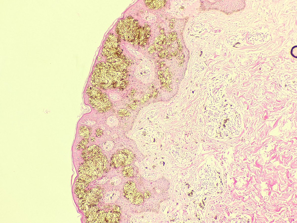 nandinipath's tweet photo. 65 year old nipple lesion . @LizaMQuintana @ADamronMD @QassidO @ashokparameswar #breastpath meets #dermpath #beautyinbenign more pictures in the second tweet https://t.co/zDVn14OGuY