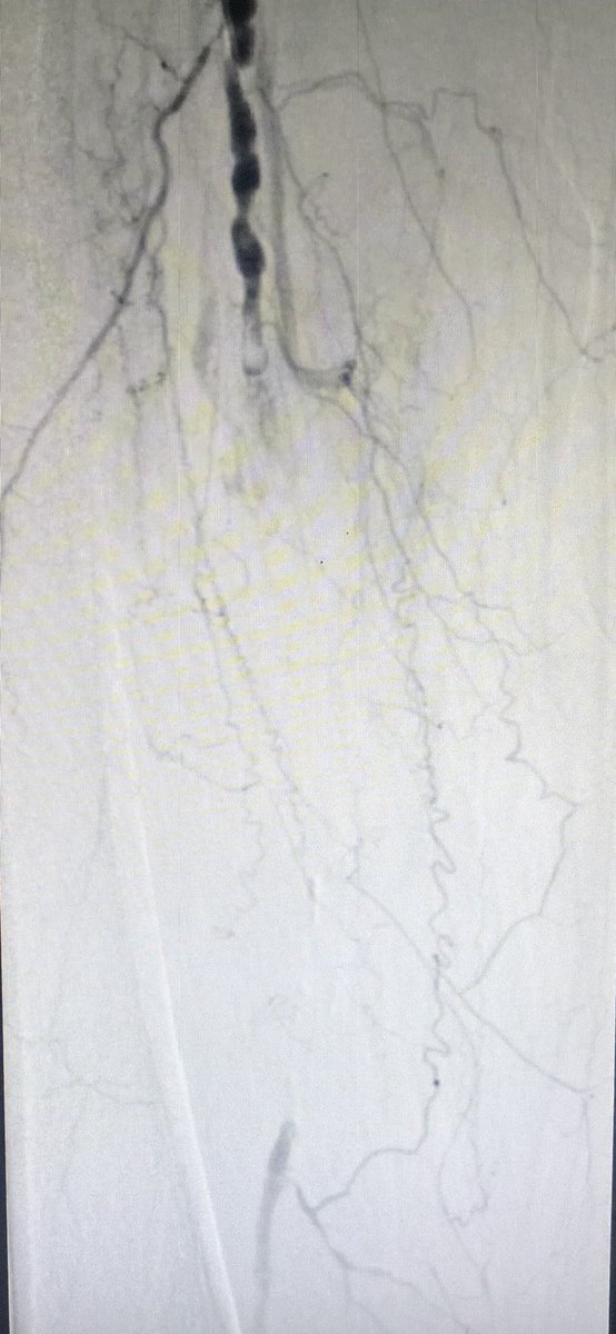 DrDhaferKamal's tweet photo. 65 years of age #diabeticfoot presenting with #ischemic rest pain and #gangrene found to have #critical lesion external #iliac #artery and multiple occlusions/stenosed #SFA with single vessel runoff #Peroneal artery. Successful #Stenting of EIA and #balloon #angioplasty of SFA https://t.co/otituf5lag