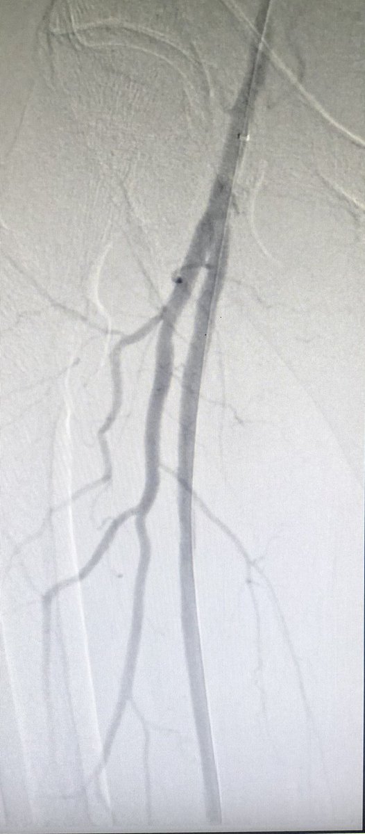 DrDhaferKamal's tweet photo. 65 years of age #diabeticfoot presenting with #ischemic rest pain and #gangrene found to have #critical lesion external #iliac #artery and multiple occlusions/stenosed #SFA with single vessel runoff #Peroneal artery. Successful #Stenting of EIA and #balloon #angioplasty of SFA https://t.co/otituf5lag