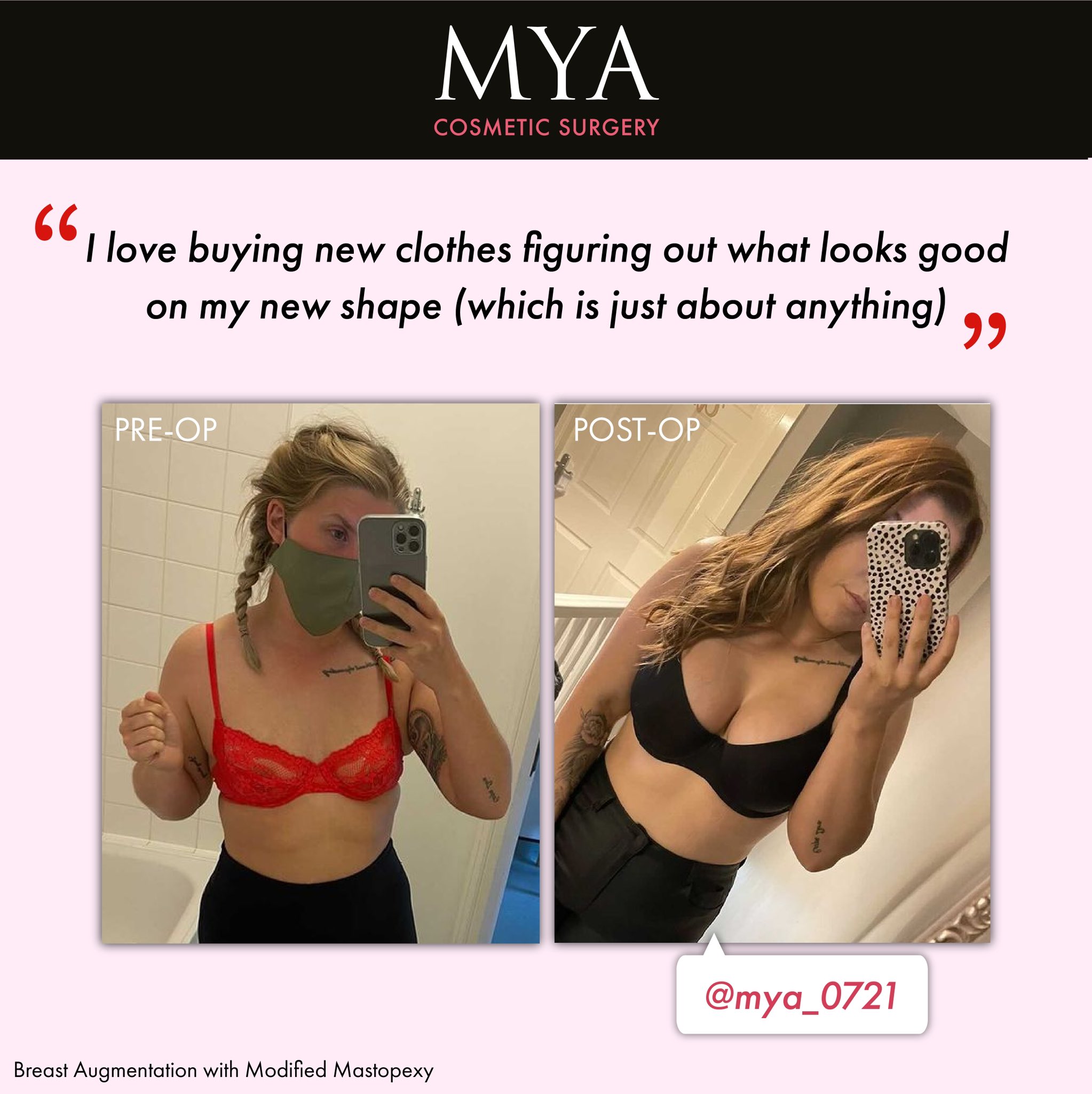 MYA Cosmetic Surgery on X: #MYAGirl mya_0721 ❤️ Breast Augmentation &  Modified Mastopexy #MYASelfie #CosmeticSurgery #Implants    / X