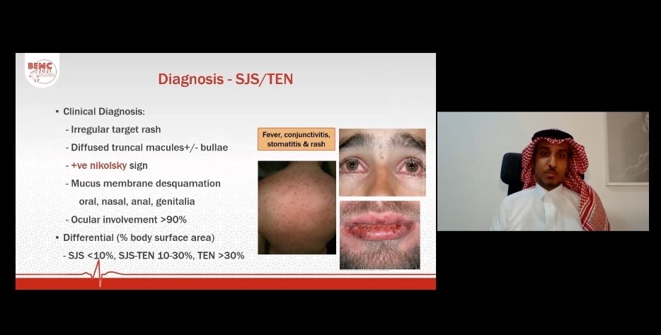 #BEMC21
Thanks for the invitation,
Rashes you cant miss in emergency
It's very important for every ER physician to not miss the life threatening rashes that you can easly safe life if you reconize it early, thanks again <a href="/dr_salah/">Salah Alghanem</a> and all orgnization committee for this opportunity