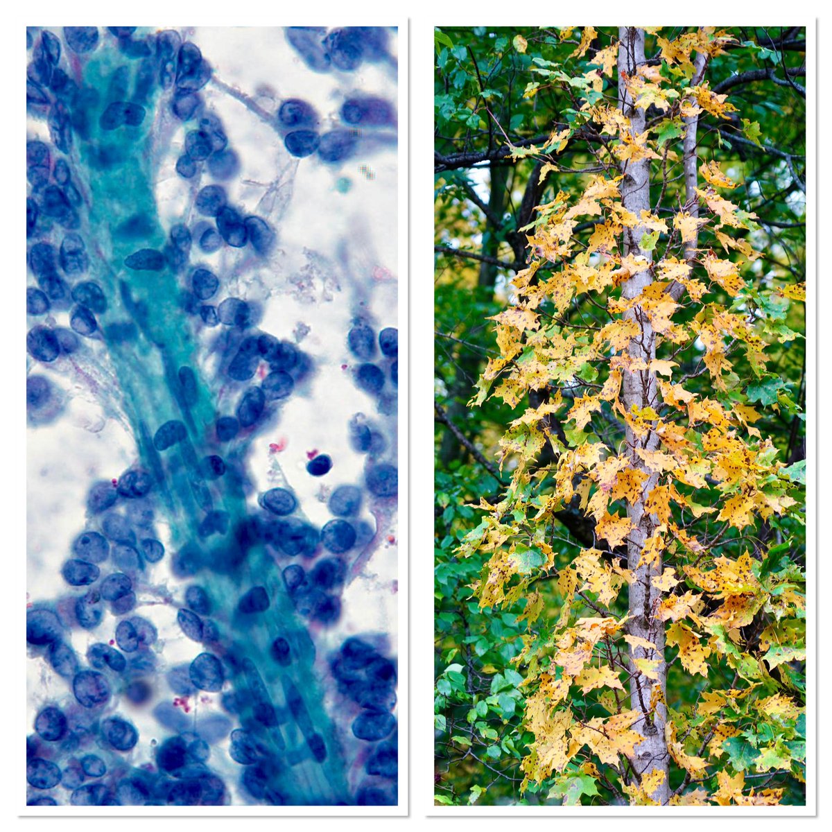 “Solid-Pseudopapillary Neoplasm (SPN)”, Pancreatic FNA.