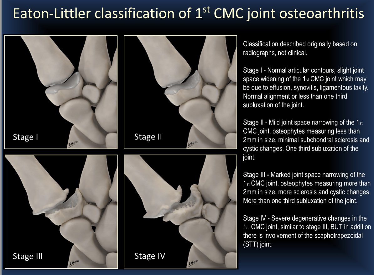 dflemosmd's tweet photo. (1/4) As requested by multiple Twitter peeps…here we go with more slides (I’ll post 16 of 35) of our #RSNA21 exhibit: 
👍“Thumbs Up Or Down? 👎 
MRI of 1st CMC Joint Arthroplasty” 
#MSKRad #orthotwitter #radres @ssr_rwg @SSRbone @intskeletal @ESSRmsk @MskSerme @ocad_msk https://t.co/Cyg6sUWqPm