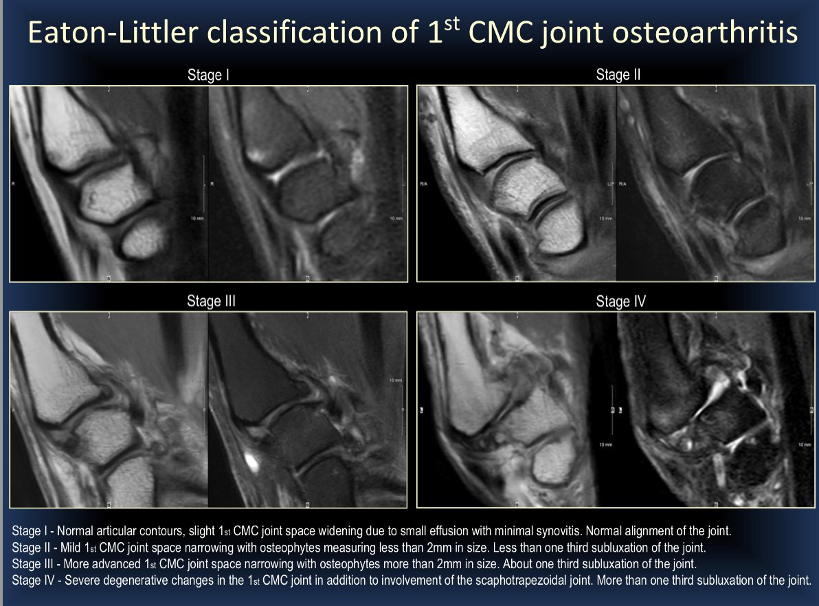 dflemosmd's tweet photo. (1/4) As requested by multiple Twitter peeps…here we go with more slides (I’ll post 16 of 35) of our #RSNA21 exhibit: 
👍“Thumbs Up Or Down? 👎 
MRI of 1st CMC Joint Arthroplasty” 
#MSKRad #orthotwitter #radres @ssr_rwg @SSRbone @intskeletal @ESSRmsk @MskSerme @ocad_msk https://t.co/Cyg6sUWqPm