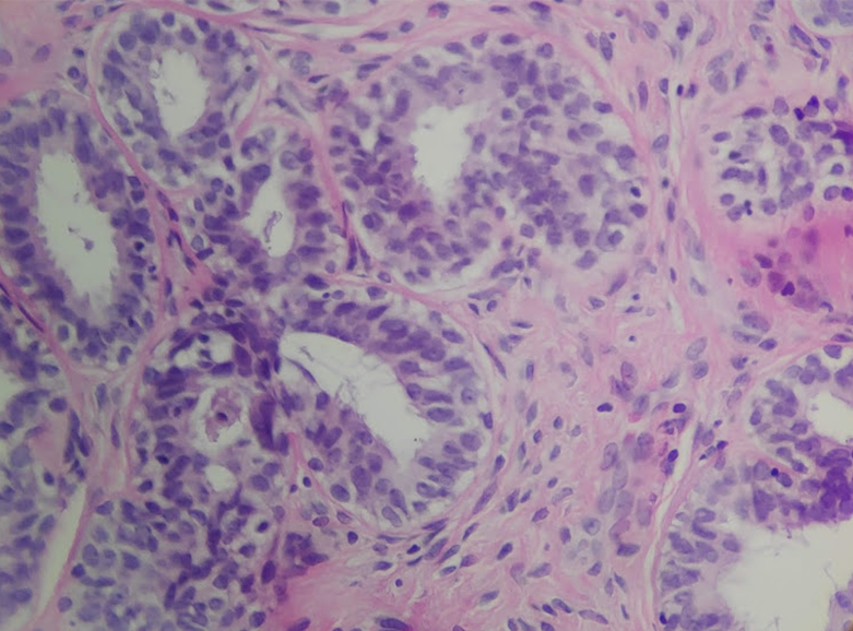 joemdoc's tweet image. Skene gland hyperplasia. Quite rare. 
#twitterPath #PathResidents #gynpath