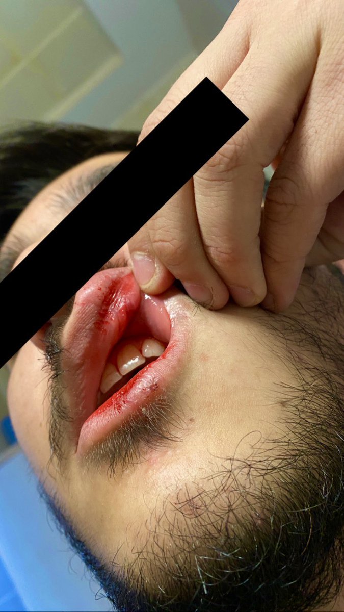 EnesSafaYurduoz's tweet photo. Herkese merhaba. Kars Harakani Devlet Hastanesi çocuk servisinde 2 yıldır görev yapmakta olan bir hemşireyim.Bugüne kadar sağlıkta şiddete hep dışardan tanık oldum, üzüldüm, yeri geldi sözel istismara maruz kaldım. https://t.co/f5xCeFKxLi