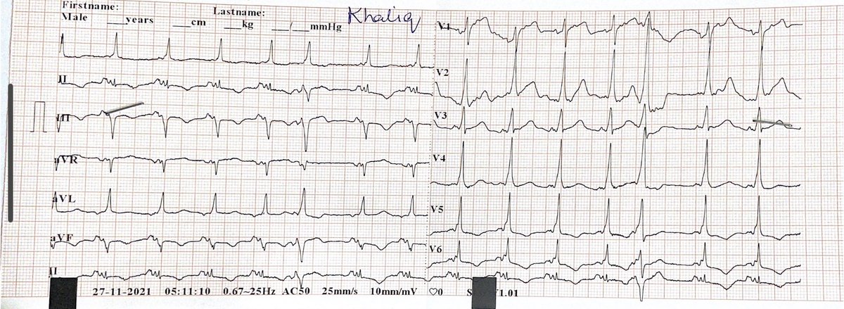 Dark69rd's tweet photo. Pathway? #medtwitter #medEd #ecghacks #cardiotwitter #EPeeps https://t.co/UCRU8YfPqW