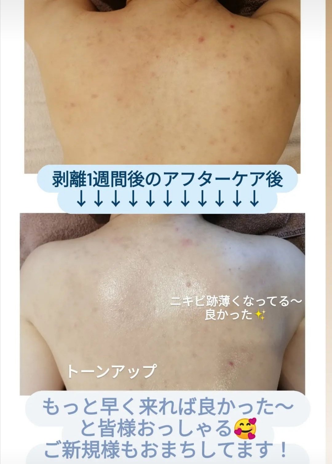 全身美肌改善REVIハーブピーリング&肉割れ炭酸ガス