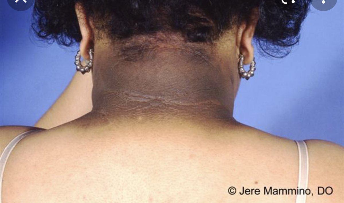 Perhatikan tanda hitam di leher pada anak, adik beradik, rakan2. Ini bukan daki, ini adalah acanthosis nigricans, salah satu tanda2 awal risiko untuk mendapat kencing manis, diabetes!

Rawatan bukan tonyoh2 je, pastikan cek paras gula dalam badan ya!

#MTMdiabetes
#seharisatuinfo