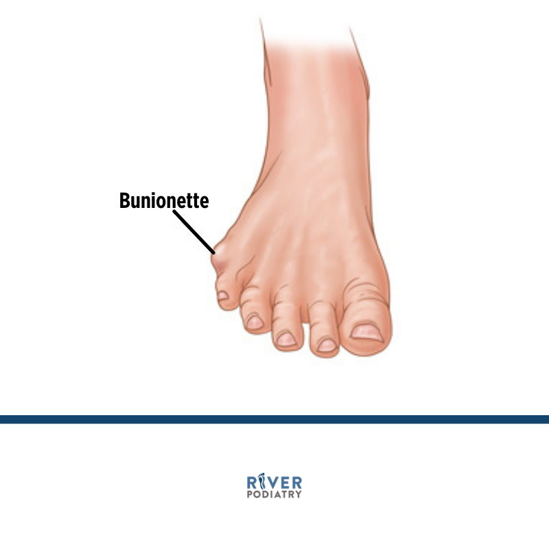 River_Podiatry's tweet photo. A bunionette is a small bunion that forms on the fifth metatarsal bone at the base of the little toe. 

Click the link below to learn more. 

https://t.co/Y07DKbMHHU https://t.co/o6Ou1Q8qPk