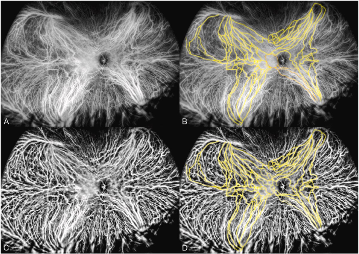 RetinaSERV's tweet photo. 👁️‍🗨️ 🌎 Cambio en el paradigma de la fisiopatología en la CSC. Alteraciones en el flujo vascular y anastomosis entre las venas vorticosas debido a escleras gruesas.
https://t.co/X0Rdy4CCk2 https://t.co/vCnQrU7Yqt