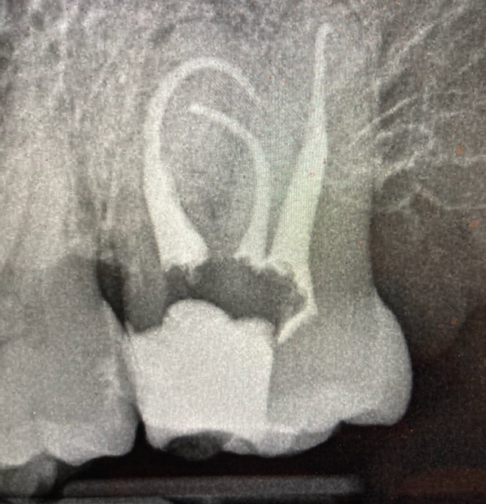 Neil4birds's tweet photo. #rootcanal #endo #endodotics now that's a badass root canal! https://t.co/PvaAjKNWnW