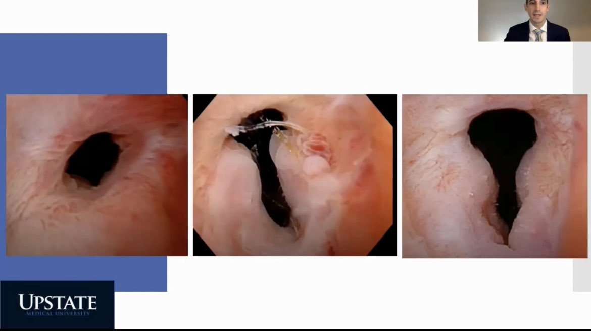 podalola's tweet photo. La cirugía robótica simplifica procedimientos que normalmente son complejos y frustrantes. Thanks @blakelyGU great motivation for mexican urologists to train in recon robotics @AmerUrological @SocietyGURS @smumexico #SMU2021 https://t.co/tkNBZvmF8w