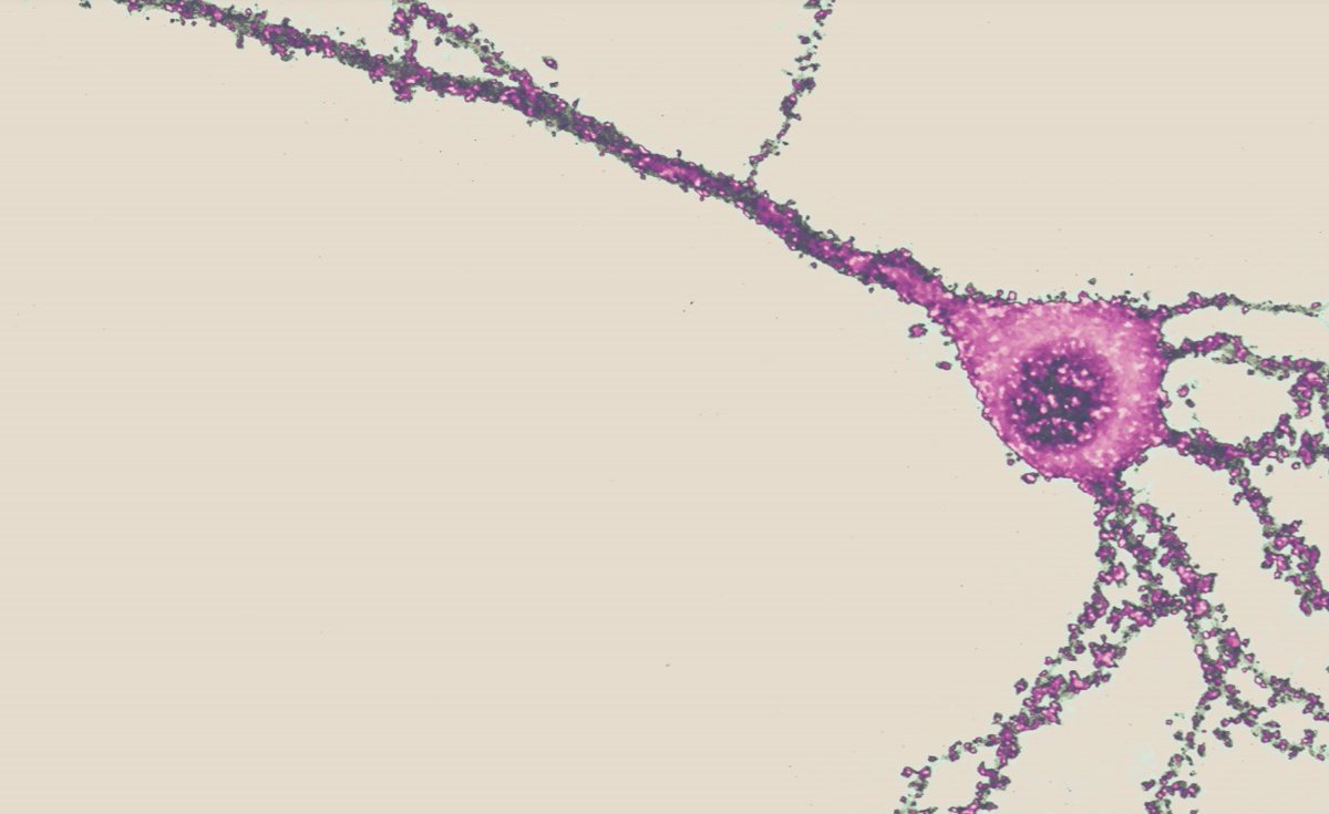 SfN Journals (@sfnjournals) on Twitter photo #JNeurosci: Tian, <a href="/beherring/">Bruce Herring</a> et al. show two proteins implicated in Autism Specturm Disorder/Intellectual Disability, Trio & Neuroligin 1, interact to promote glutamatergic synaptogenesis. When disrupted, this pathway may contribute to ASD/ID development.
jneurosci.org/lookup/DOI/10.… #JNeurosci: Tian, <a href="/beherring/">Bruce Herring</a> et al. show two proteins implicated in Autism Specturm Disorder/Intellectual Disability, Trio & Neuroligin 1, interact to promote glutamatergic synaptogenesis. When disrupted, this pathway may contribute to ASD/ID development.
jneurosci.org/lookup/DOI/10.…