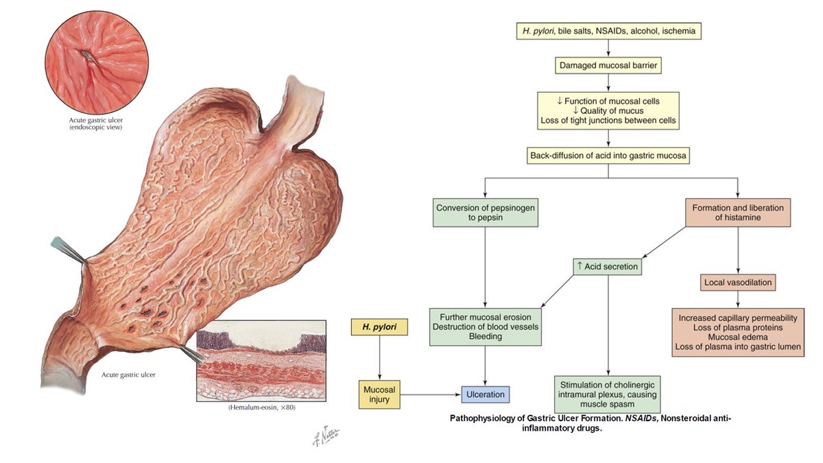 edgarvlermamd's tweet photo. Gastric Ulcer: Pathophysiology
#PathophysiologyPearls #IMpearls https://t.co/bOKettJL8c