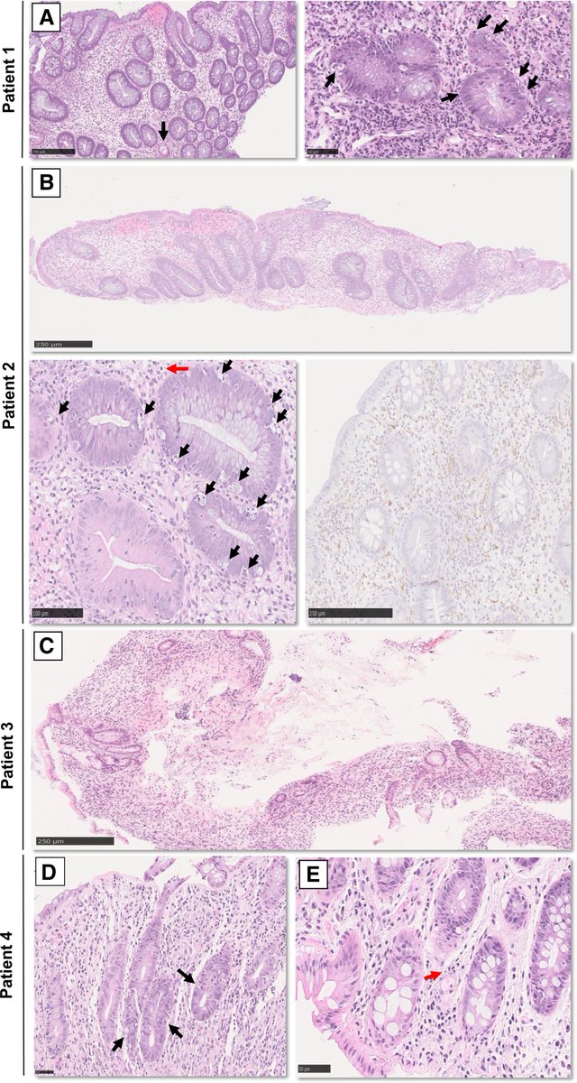 JPGNReports's tweet image. Don&apos;t miss this release from @jpgnreports on the first cases of biopsy-confirmed MMF-induced colitis reported in autoimmune polyendocrinopathy-candidiasis-ectodermal dystrophy (APECED)

journals.lww.com/jpgnr/pages/im…

#pedgitwitter
