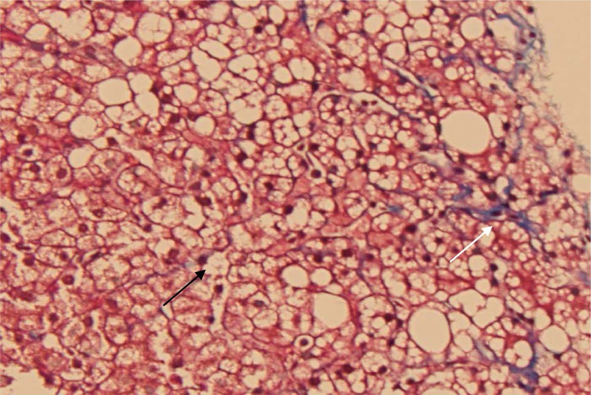 JPGNReports's tweet image. Read more about this #casereport of a 10-year-old Kurdish male patient with #ichthyosis referred for transaminase elevation of unknown etiology

journals.lww.com/jpgnr/pages/im…

#pedgitwitter #ChanarinDorfmanSyndrome