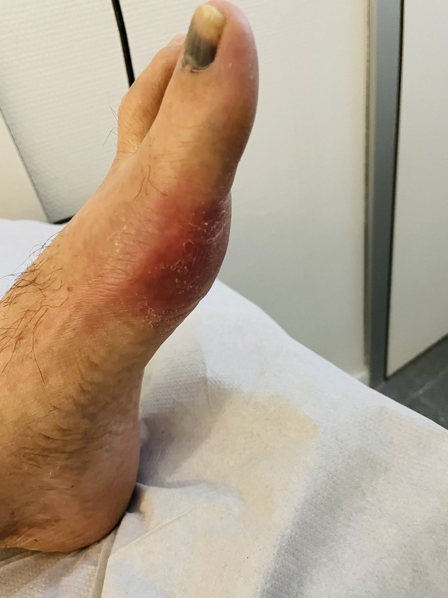 enriquecalvoA's tweet photo. Podagra
#gout #uric #uricacid #urate #bigtoe #arthritis #crystals #tophus #ultrasound #rheumatology 
@drmariochavez @pompermarioMD @UltrasoundRheum @drrheumatocito1 @cesardiaztorne @LuisTorrens00 @basiliu @BorisBlancoC @ALGaffoRheumMD @SaraKTedeschi @NicolaDalbeth @Tuhina_Neogi https://t.co/y6DCMSKtb9