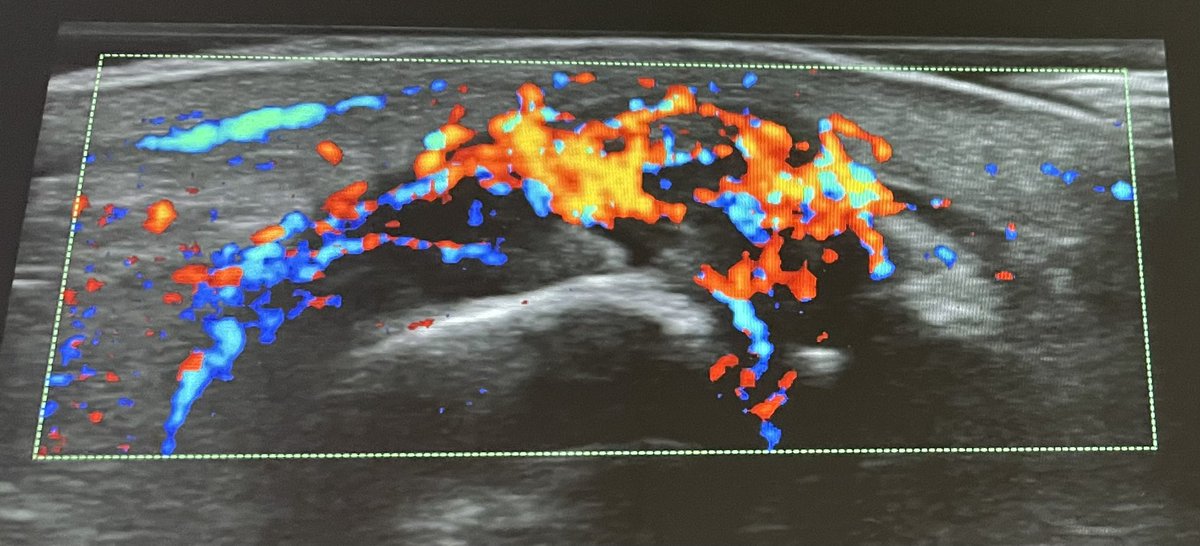 enriquecalvoA's tweet photo. Podagra
#gout #uric #uricacid #urate #bigtoe #arthritis #crystals #tophus #ultrasound #rheumatology 
@drmariochavez @pompermarioMD @UltrasoundRheum @drrheumatocito1 @cesardiaztorne @LuisTorrens00 @basiliu @BorisBlancoC @ALGaffoRheumMD @SaraKTedeschi @NicolaDalbeth @Tuhina_Neogi https://t.co/y6DCMSKtb9