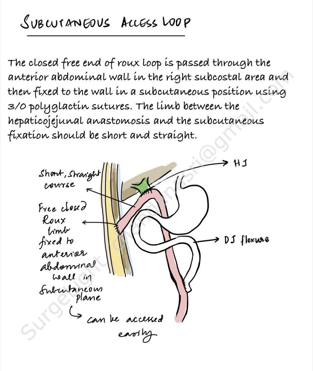 Modifications of Hepaticojejunostomy technique to provide permanent endoscopic access. #SoMe4Surgery #SoMe4HPB 

(Courtesy of Surgelight)