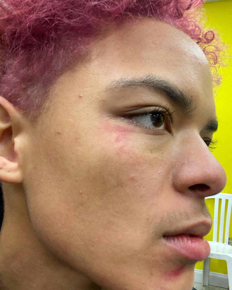 EzraAfterr's tweet photo. TW; Assault, Blood
On Nov 26th I was violently arrested, misgendered and assaulted by @HamiltonPolice After showing up to support my friends and family advocating for houseless people in Hamilton. Please tune into the press conference streaming from @HamOntESN tomorrow morning. https://t.co/yjYu4YSY2r