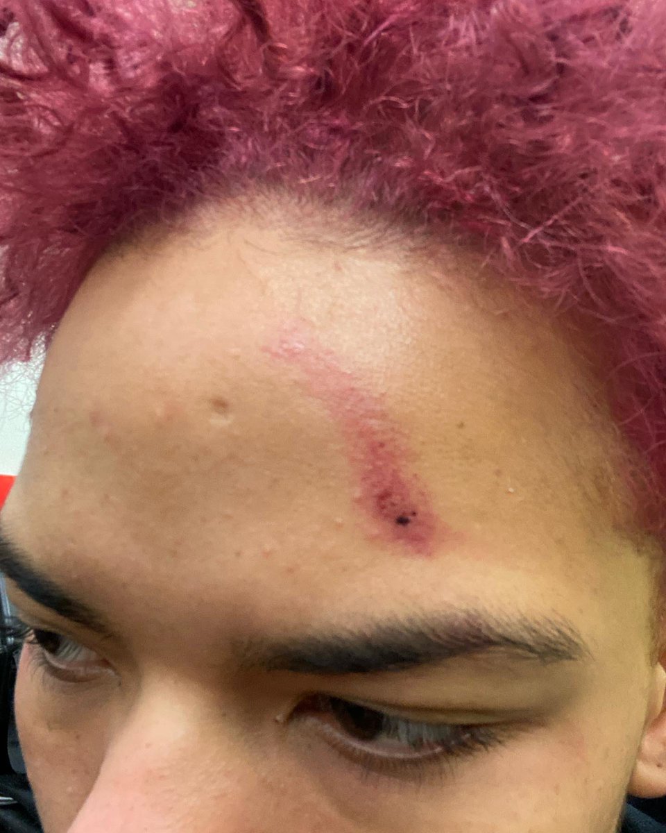 EzraAfterr's tweet photo. TW; Assault, Blood
On Nov 26th I was violently arrested, misgendered and assaulted by @HamiltonPolice After showing up to support my friends and family advocating for houseless people in Hamilton. Please tune into the press conference streaming from @HamOntESN tomorrow morning. https://t.co/yjYu4YSY2r