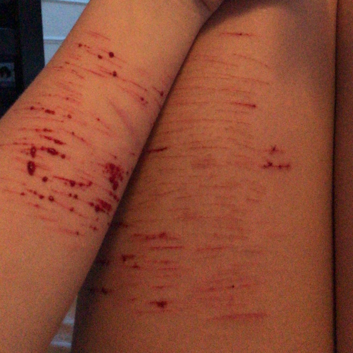 slitdown's tweet image. tw sh /
-
-
-
-
-
my arm burns. it feels so good.