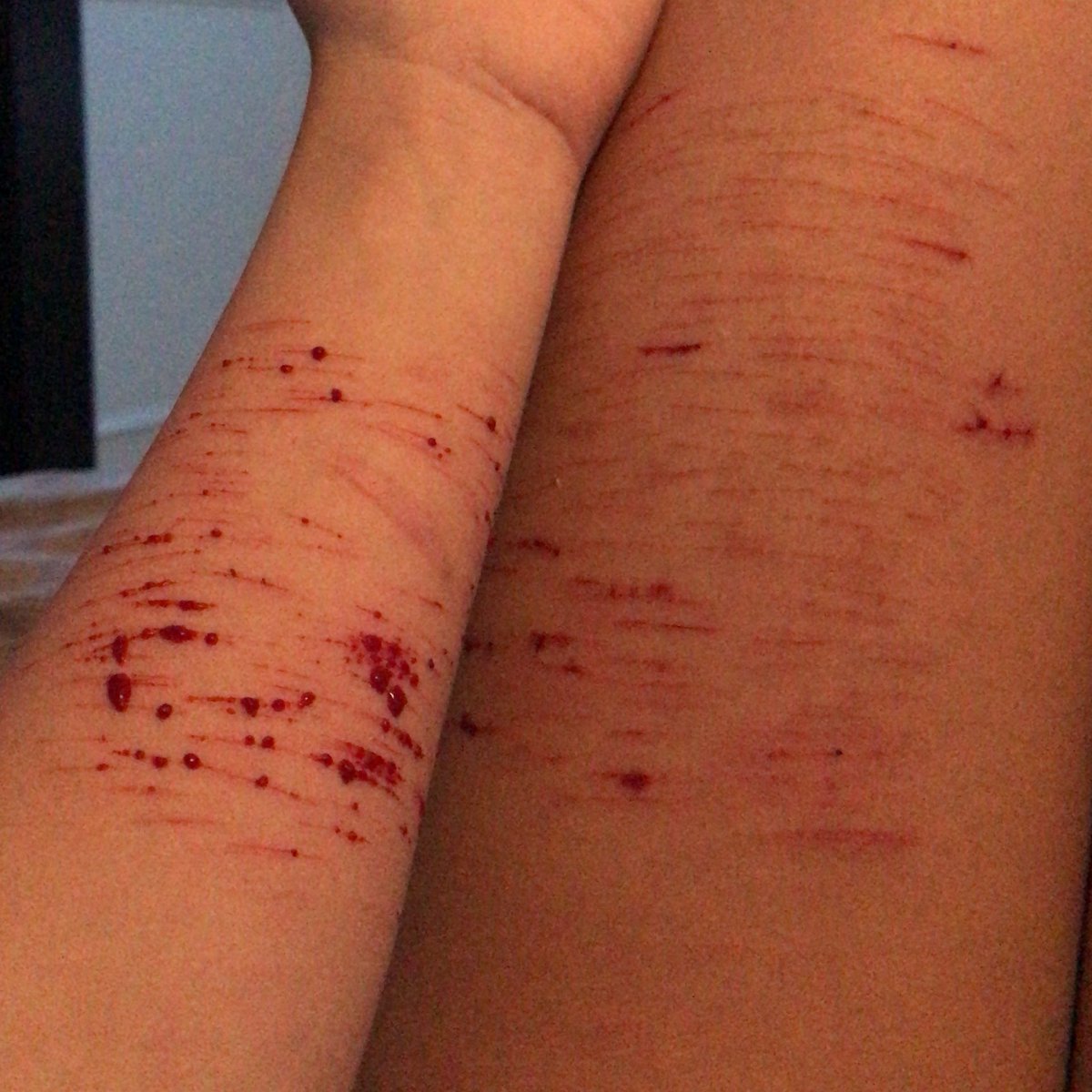 slitdown's tweet image. tw sh /
-
-
-
-
-
my arm burns. it feels so good.