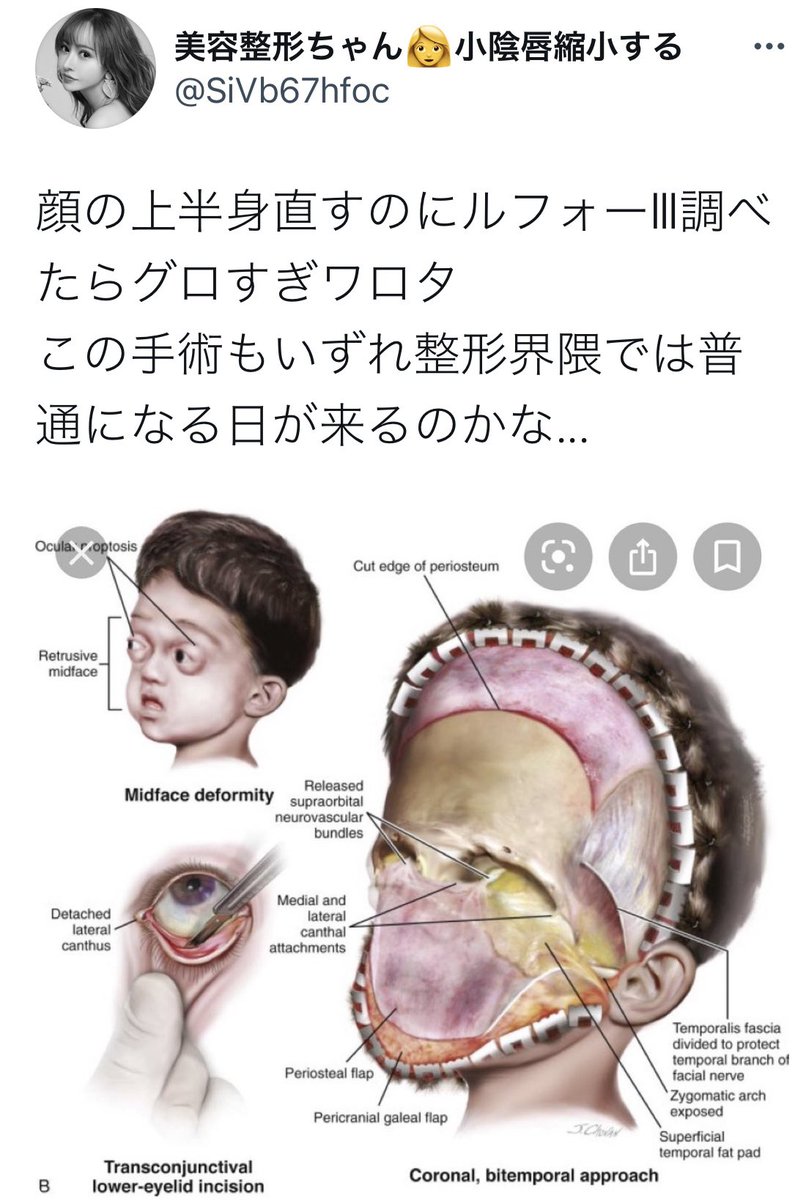 SiVb67hfoc's tweet photo. 顔面上半身の歪み(目、眉の高さ非対称)が一生コンプだったんだけどまさかの額ボト調整で揃った。左右非対称だった二重幅も揃った。たった数万円でこの手術も必要なくなってしまった。嬉しすぎる。ただボトは失敗したら３ヶ月地獄を見るから先生が超重要。打てばいいっても��じゃない。 https://t.co/uLeEritCd8