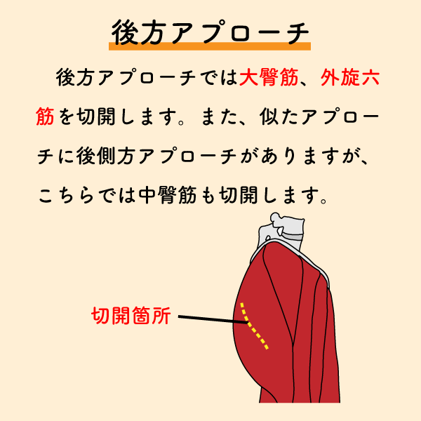 riha_note's tweet photo. THA術後のリハで着目すべき筋肉💡

これらの筋肉が切開されることが、術後疼痛や可動域制限の原因の1つとなります。
術式によっても変わるため、リハビリ担当者は主治医の確認も必ず取りましょう。 https://t.co/zSCCqDwMI1