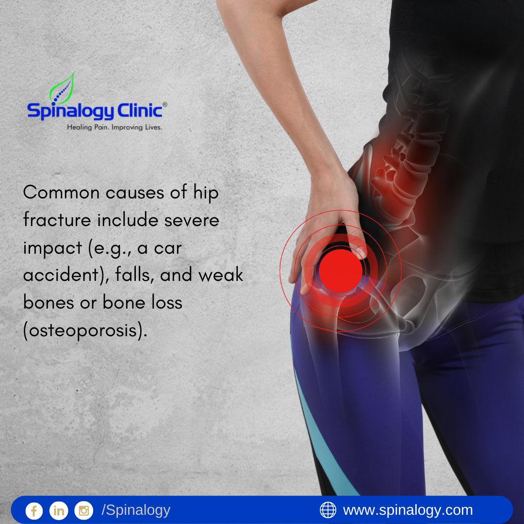 spinalogy's tweet photo. Common causes of hip fracture include severe impact (e.g., a car accident), falls, and weak bones or bone loss (osteoporosis).
#Spinalogy #SpinalogyClinic #OrthopedicDoctor #SpinalogyPune #HipFracture #BoneLoss #WeakBone #BoneHealth https://t.co/BJKwtlXxHw