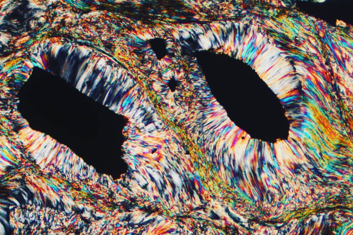alexstrekeisen's tweet photo. Stichtite: a rare Cr-rich carbonate, Mg6Cr3+2(OH)16[CO3] · 4H2O
______________
Fibrous stichtite crystals, grown around chromite crystals in a serpentine from Australia. Stichtite show pale pink colors, and very high Interference colors. PPL and XPL image, 10x (Fov 2mm) https://t.co/EEmTKA8SQw