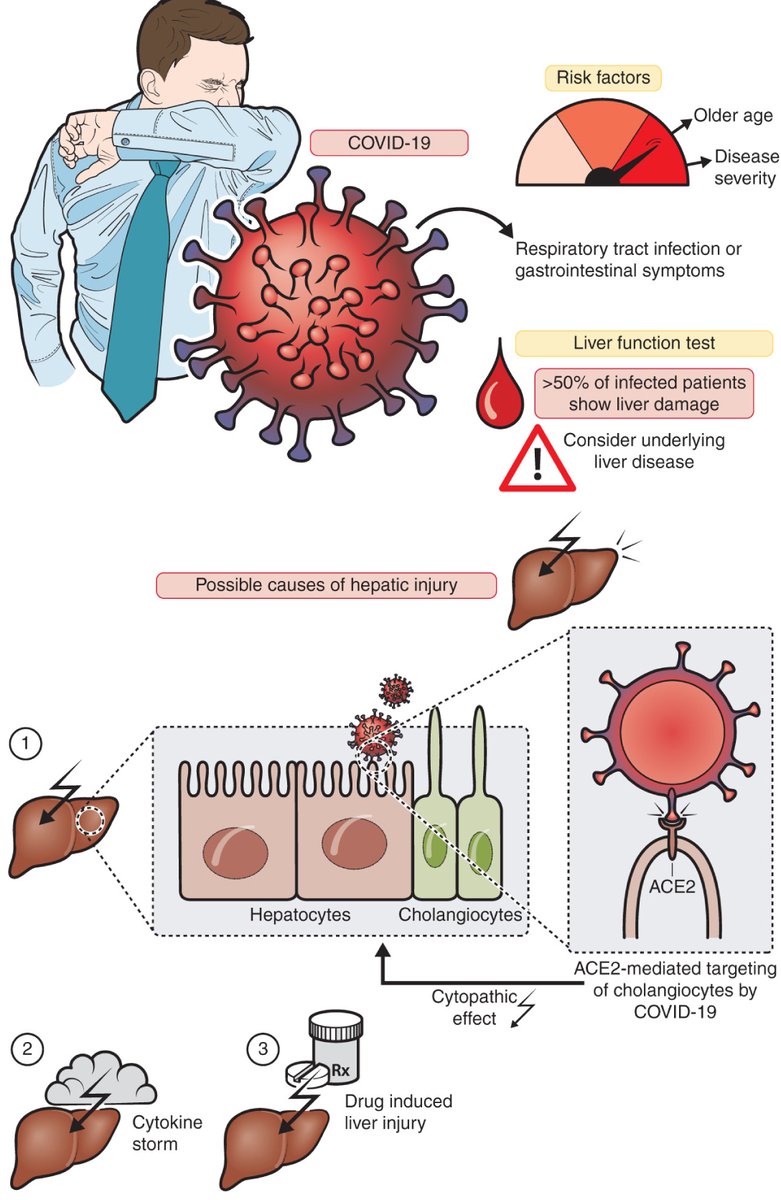joostphdrenth's tweet image. Liver injury in #COVID19 : The current evidence 

@schattenbergJ paper provides the best evidence that is out there @uegjournal 
#livertwitter #medtwitter 
onlinelibrary.wiley.com/doi/10.1177/20…