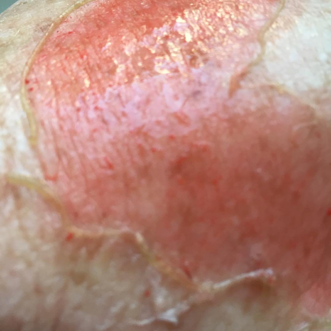 MoulageMumma's tweet photo. Simple Burn #MoulageMonday #NotJustASimTech #MakeLearningComeToLife #SimTechsRock #SimulationRocks #MoulageRocks
@sirmanfer @ASPiHUK
@AspihTechSig @HealthySim #Fake #makeup
@simulationtek @BeReadyNHC @TXSIMTECH
@SSHorg #SimTribe @sim_aware https://t.co/mj59E1MsUH