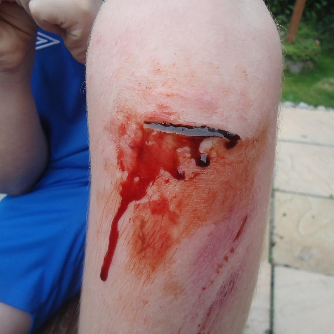 MoulageMumma's tweet photo. A cut knee #TraumaTuesday #NotJustASimTech #MakeLearningComeToLife #SimTechsRock #SimulationRocks #MoulageRocks
@sirmanfer @ASPiHUK
@AspihTechSig @HealthySim #Fake #makeup
@simulationtek @BeReadyNHC @TXSIMTECH
@SSHorg #SimTribe @sim_aware https://t.co/EAxfWubuFY