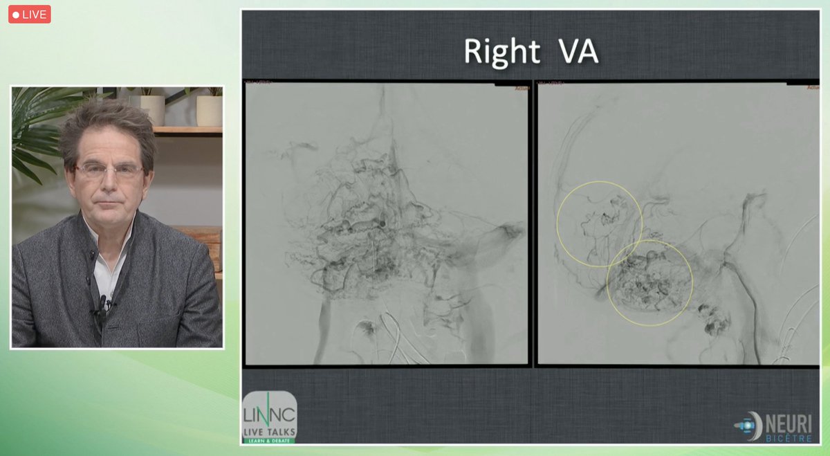 LINNConline's tweet photo. Second recorded #case: An osteodural #arteriovenous malformation treated with a liquid embolic. Should we preserve the #patency of the sinus? 🧠
Discussion on whether or not this is clinically advisable.⬇

#LINNCLT https://t.co/9pfGfWga2E