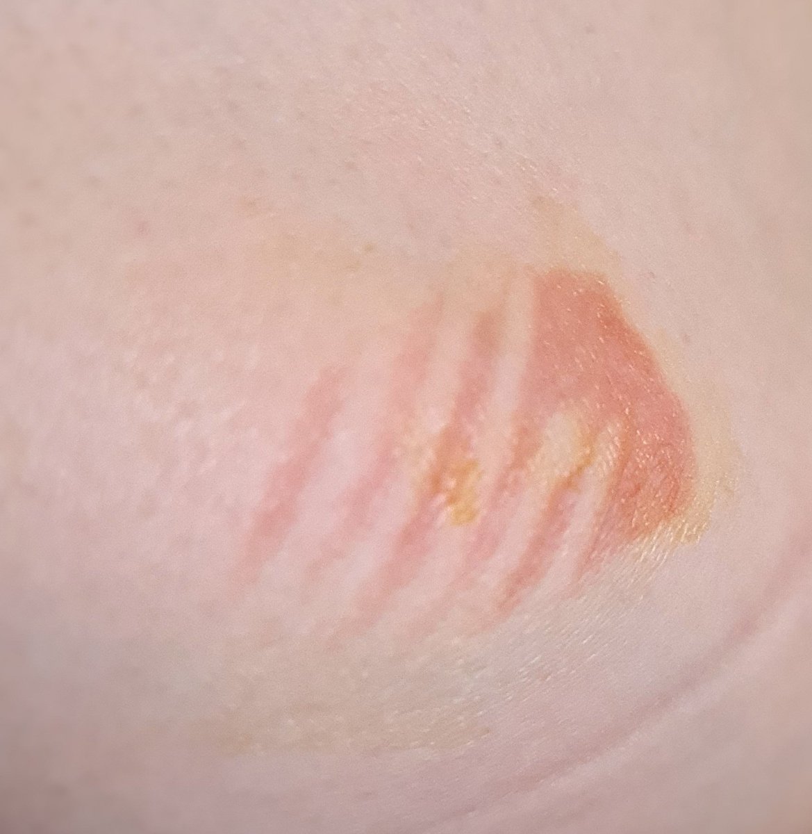 Safe_For_Work's tweet photo. So sieht übrigens eine knapp 2 Tage alte Verbrennung von einem Schlagbohrer für Beton aus, in Behandlung mit heimischem Aloe-Saft.
Der Bohrer ist nicht mal ne Sekunde lang gegen meinen Arm geditscht, lief nicht mehr sondern war "nur noch" heiß vom Betrieb vorher. https://t.co/TLdv4kz89J