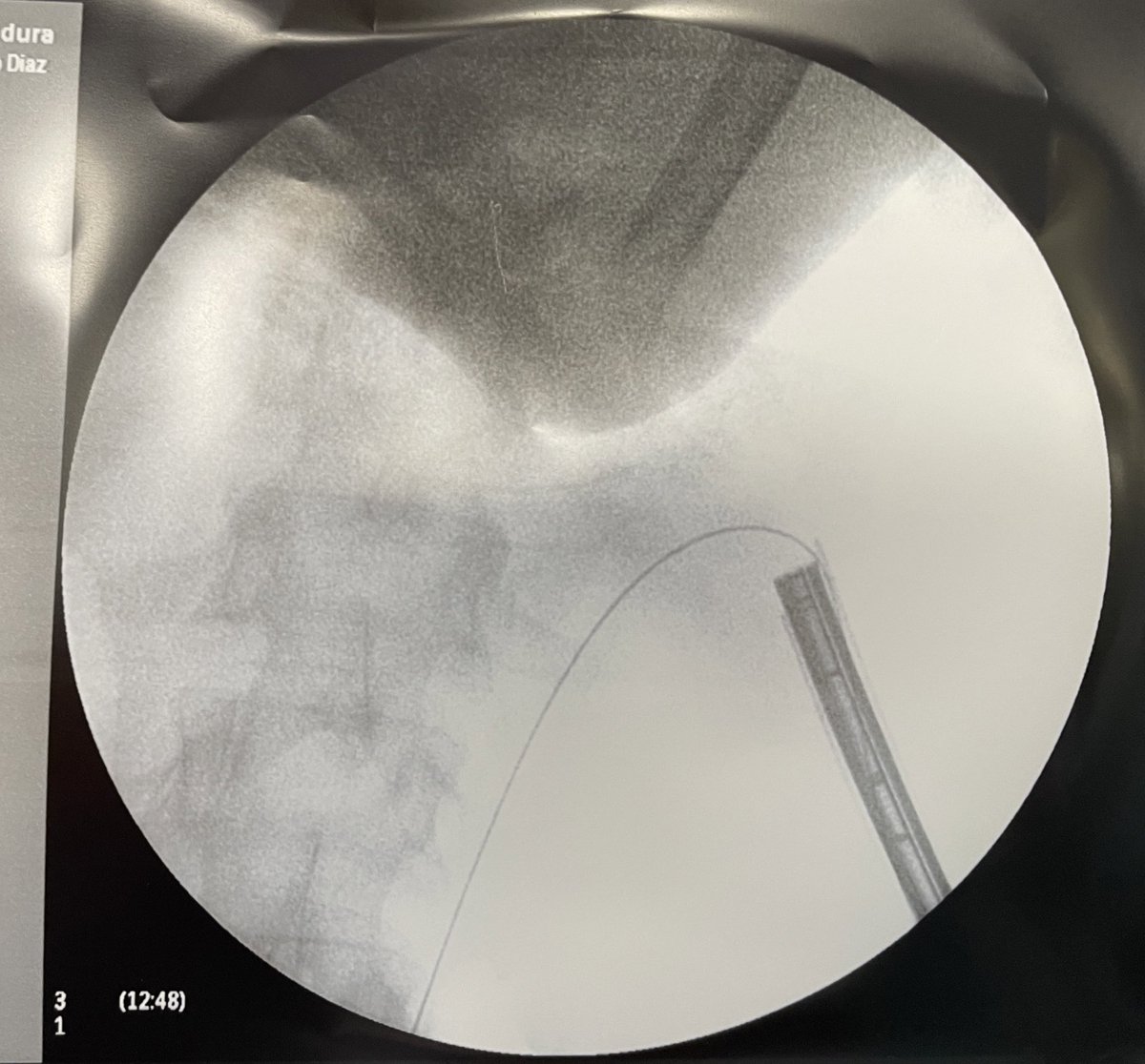 Today, standard 24 Ch supine PCNL, <a href="/GuidoGiusti/">Guido Giusti</a> ’s position. Ho-YAG laser lithotripsy… Dear Santa: a Lithoclast/Shockpulse… or something! Please!! #UroSoMe <a href="/ResidentesAEU/">RAEU - Spanish Urology Residents Working Group</a> <a href="/EndoLapRobAEU/">Lit/Endo/Lap/Rob AEU</a>
