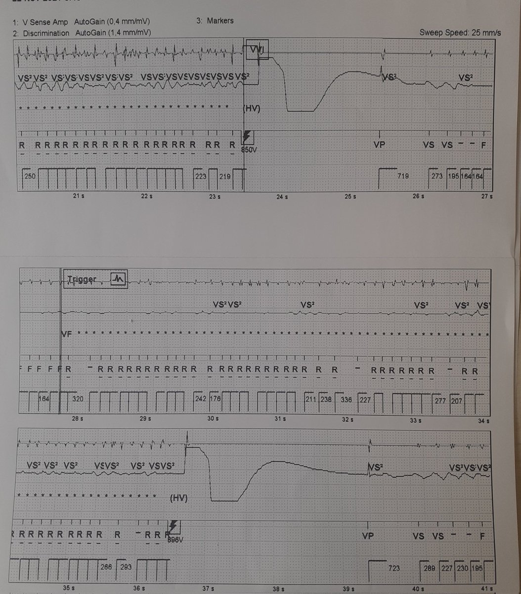 PhilDurkin3's tweet photo. What a cool algorithm VF Therapy assurance (VFTA). Not seen it in action until today. Was initially sceptical. Allows the patient to receive potentially life saving therapy when undersensensing of VF/VT Occurs
#ICD #VFTA https://t.co/yRNiMYCfAB