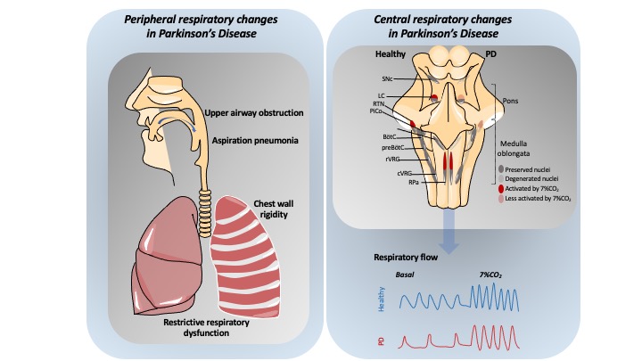 JNeurophysiol's tweet image. #ArticlesinPress - &quot;Respiratory disorders of Parkinson&apos;s Disease&quot;
Yasmin C Aquino, et al.
#Neuralcontrol  #Chemosensibility #Neuroscience
@ThiMoreira @TakakuraAna @Unesp_Global
ow.ly/nVnZ50GVIHJ